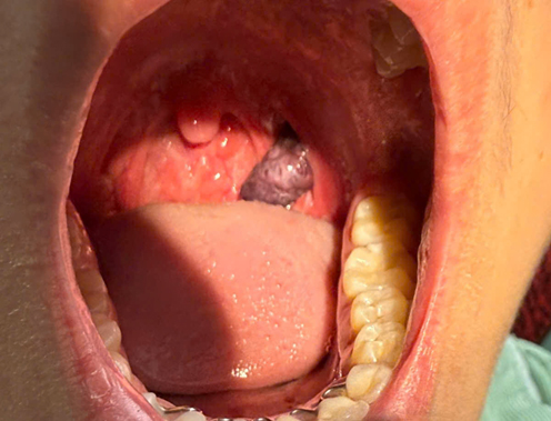 Lấy khối u máu hiếm gặp trong họng bệnh nhi- Ảnh 3.