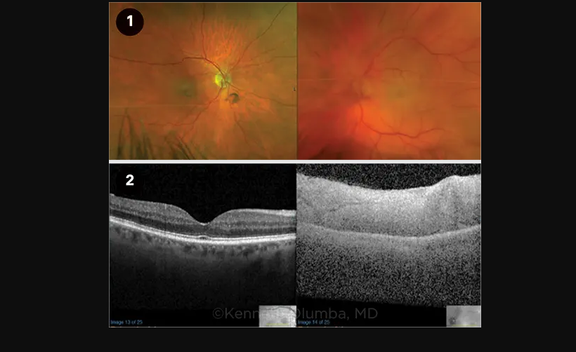 Mất thị lực sau một đêm: Cảnh báo khẩn cấp về tắc động mạch mắt- Ảnh 1.