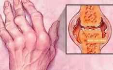 Viêm khớp dạng thấp ảnh hưởng đến cơ thể như thế nào?