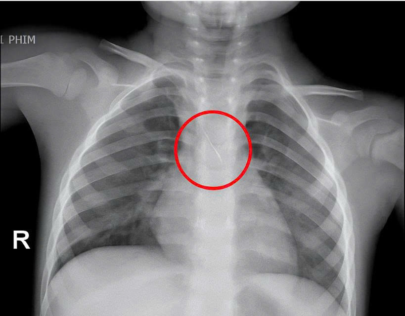 Kim chọc tủy bất ngờ rơi xuống đường thở bé 3 tuổi- Ảnh 1. Kim chọc tủy bất ngờ rơi xuống đường thở bé 3 tuổi- Ảnh 1.