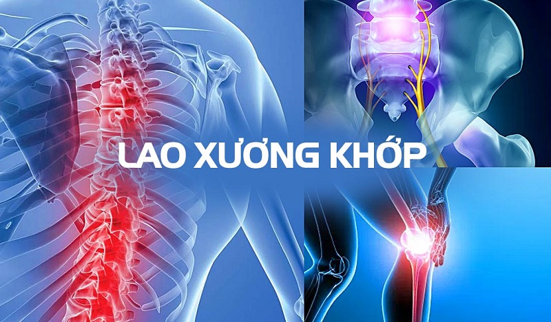 Ai là người dễ bị lao xương khớp?- Ảnh 1. Ai là người dễ bị lao xương khớp?- Ảnh 1.
