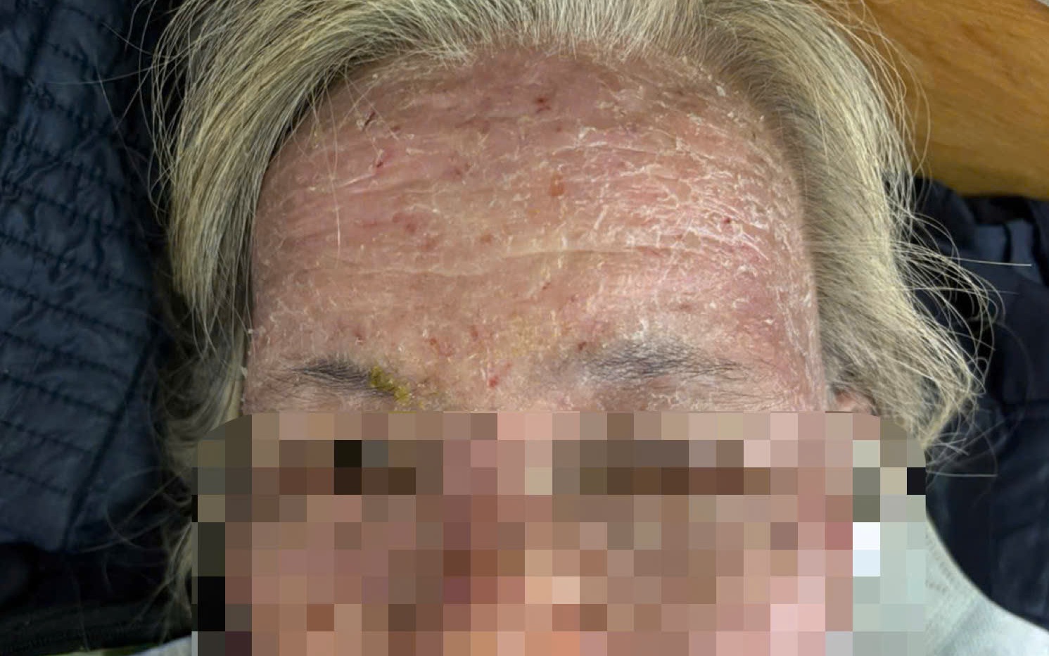 Máy cắt làm lóc da 3 ngón tay, hoại tử xương- Ảnh 1.