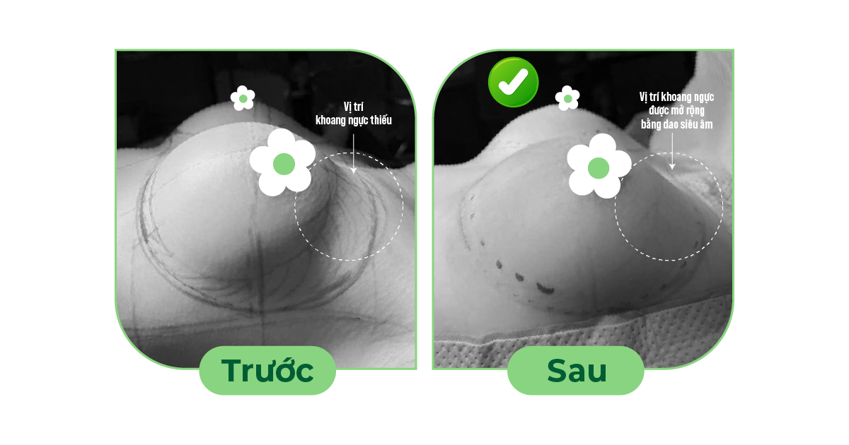 Tháo túi ngực và thay túi ngực: Phương pháp gây mê, kỹ thuật phẫu tích, hồi phục- Ảnh 2.