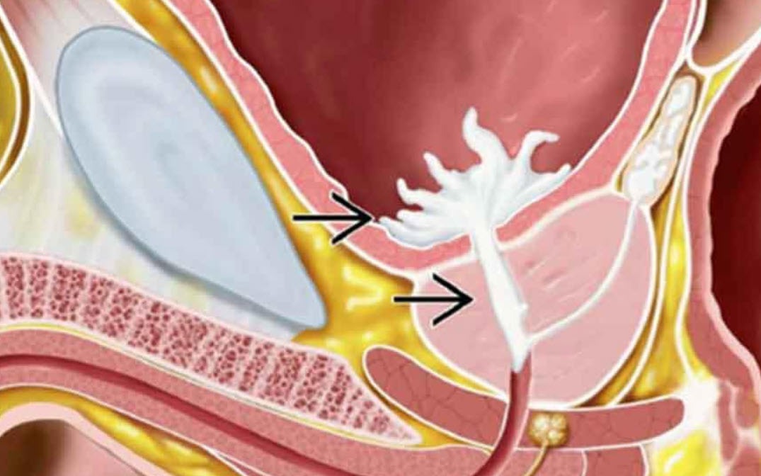 Không thấy tinh dịch sau quan hệ cảnh báo xuất tinh ngược