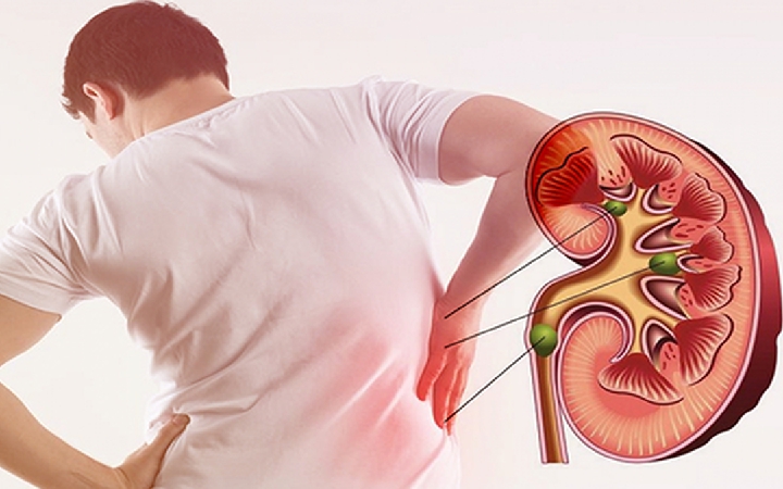 Sỏi san hô trong thận là gì, có nguy hiểm không?- Ảnh 2.