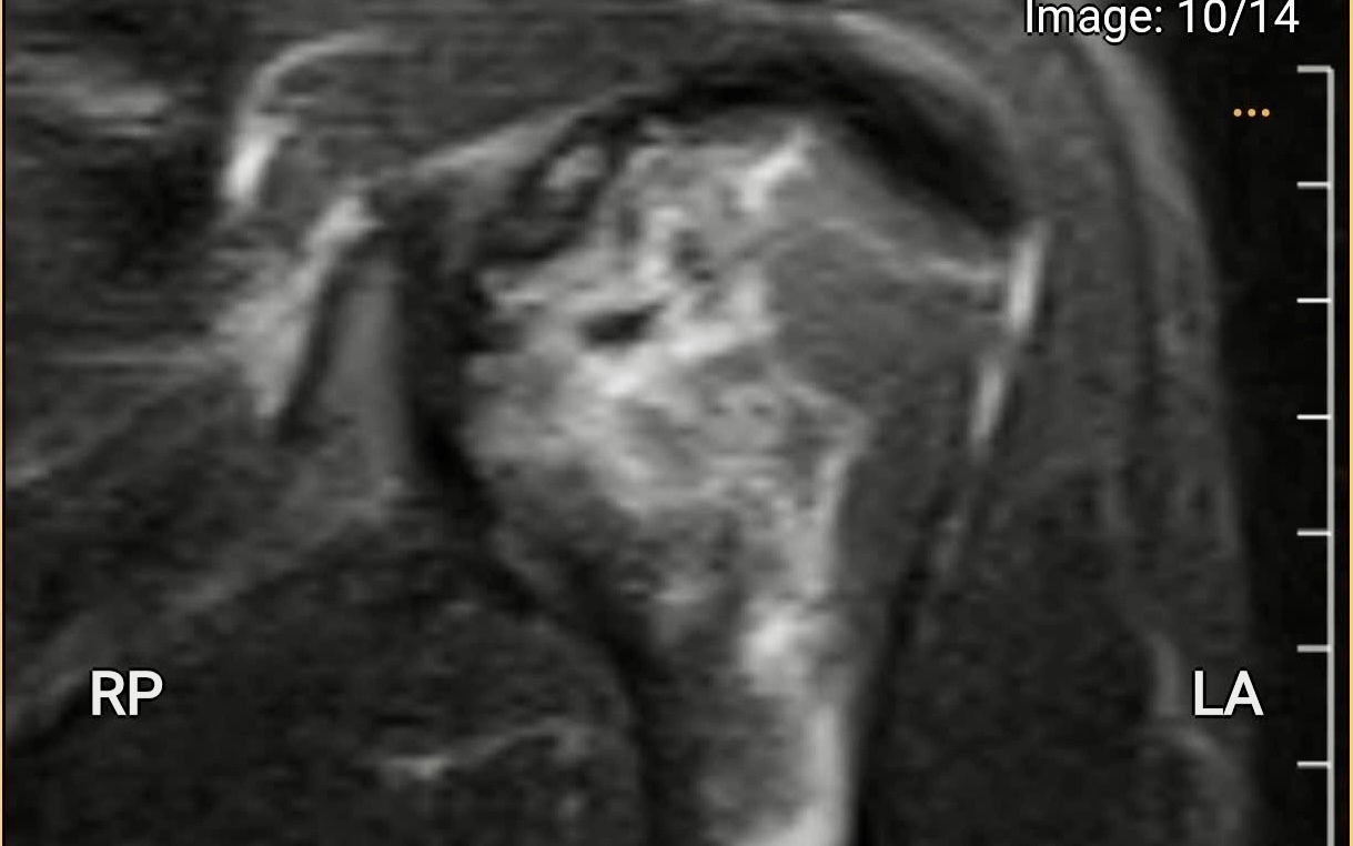 Thợ lặn biển hơn 20 năm bị hoại tử xương cánh tay, xương đùi