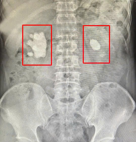 Que sont les calculs rénaux coralliens et sont-ils dangereux ? - Photo 1. Sỏi san hô trong thận là gì, có nguy hiểm không?- Ảnh 1.