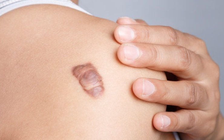 Chữa sẹo lồi có khó không?