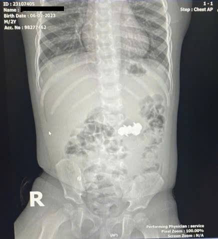 Boy swallows 4 dangerous sharp magnetic nails - Photo 1. Bé trai nuốt 4 viên đinh nam châm đầu nhọn nguy hiểm
- Ảnh 1.