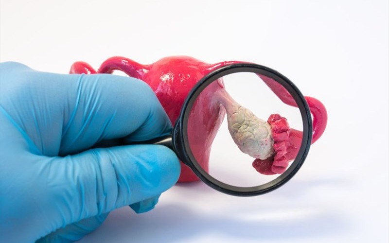 7 loại gia vị tốt cho người mắc hội chứng buồng trứng đa nang- Ảnh 4. Dấu hiệu buồng trứng đa nang thường gặp