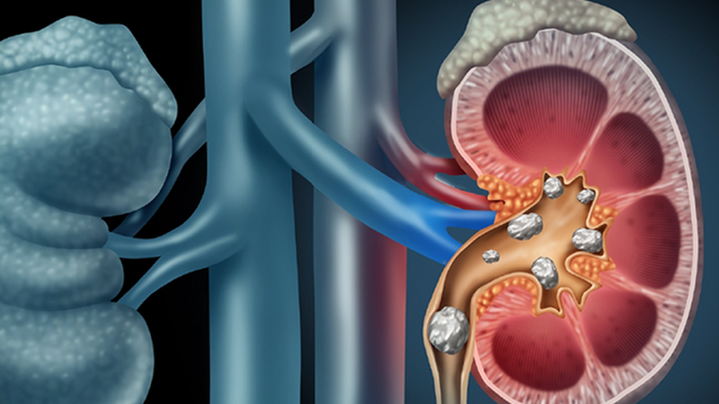 Ryggsmerter, urininkontinens, forebygging av nyrestein - Bilde 1. Đau lưng, tiểu són đề phòng sỏi thận- Ảnh 1.