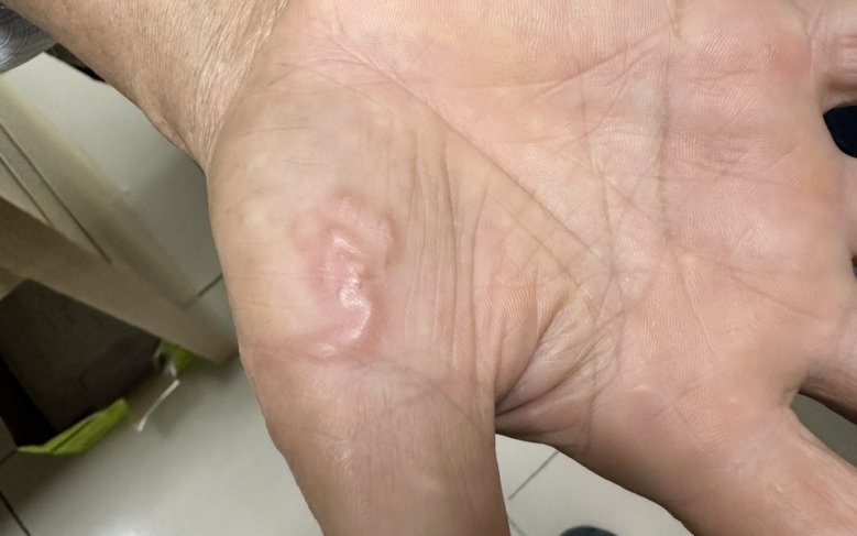 Biểu hiện mắc giun sán cần đi khám sớm, khám ở đâu?