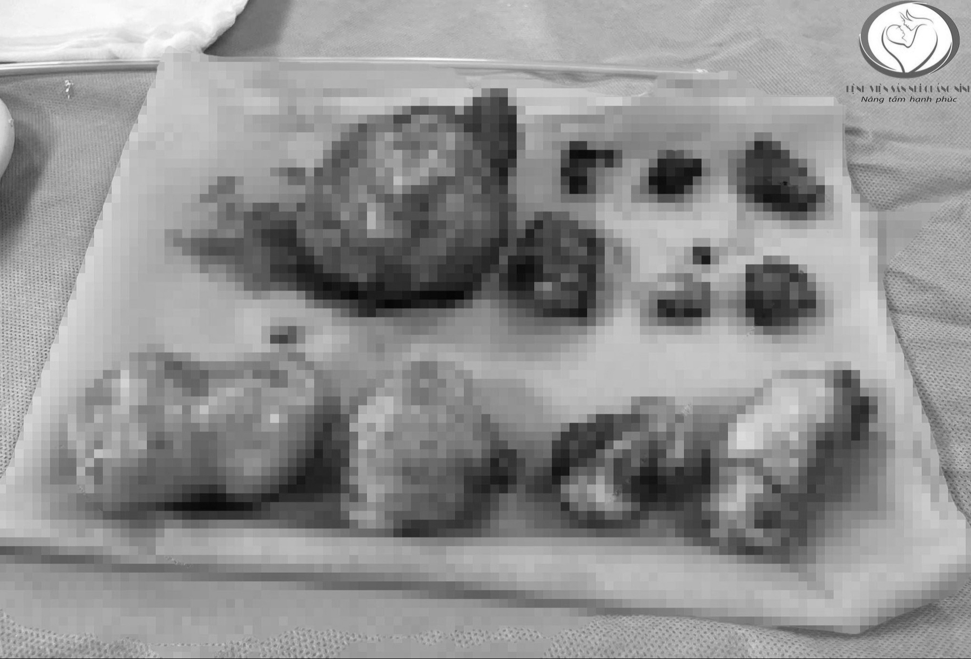 एक बांझ महिला में 11 जटिल फाइब्रॉएड हैं - फोटो 1. Một phụ nữ hiếm muộn mang trong mình 11 khối u xơ phát triển phức tạp- Ảnh 1.