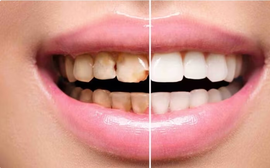 Lấy cao răng bằng hệ thống khí mu - Ảnh 2.