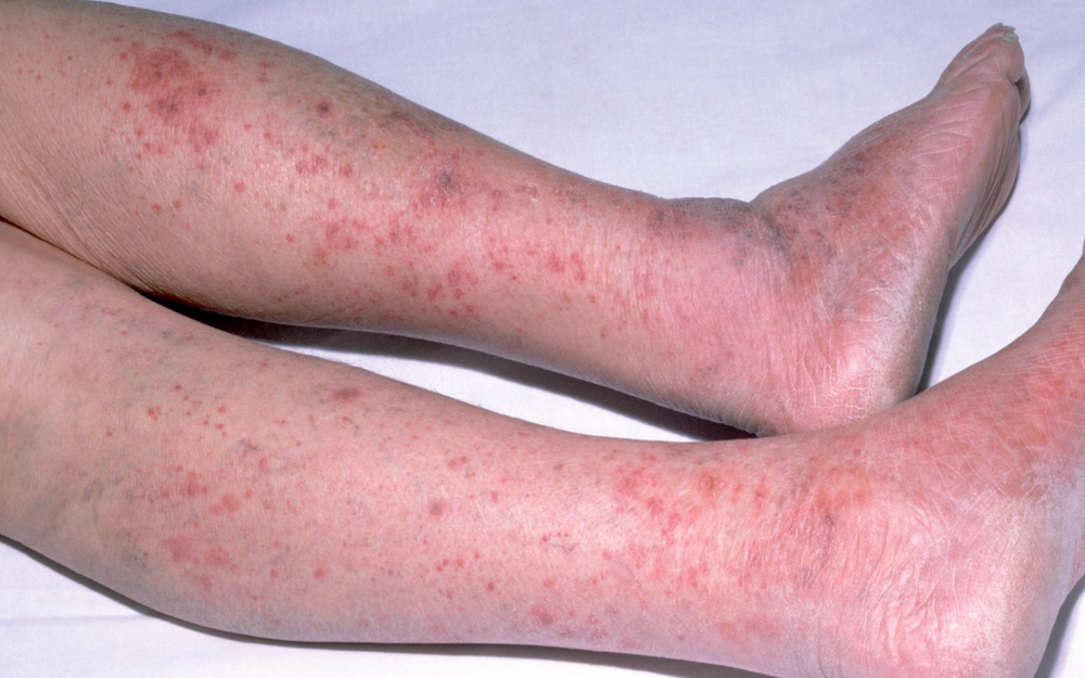 Lâm Đồng giám sát người tiếp xúc gần sau ca bệnh viêm màng não mô cầu- Ảnh 1.