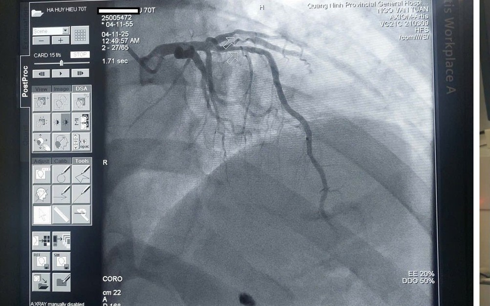 Hồi sinh sự sống cho cụ ông 70 tuổi bị nhồi máu cơ tim cấp trong đêm