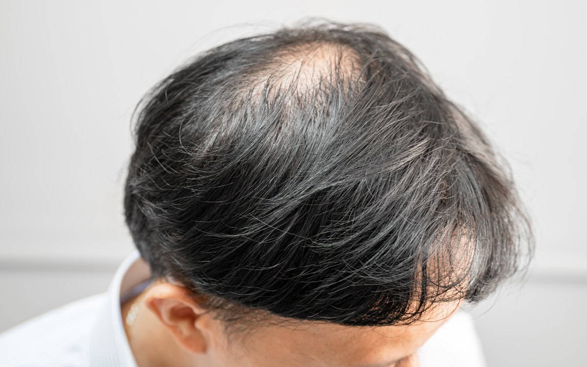 Rụng tóc nhiều vào mùa đông: Bác sĩ chỉ 3 sai lầm khi gội sấy và 4 cách khắc phục