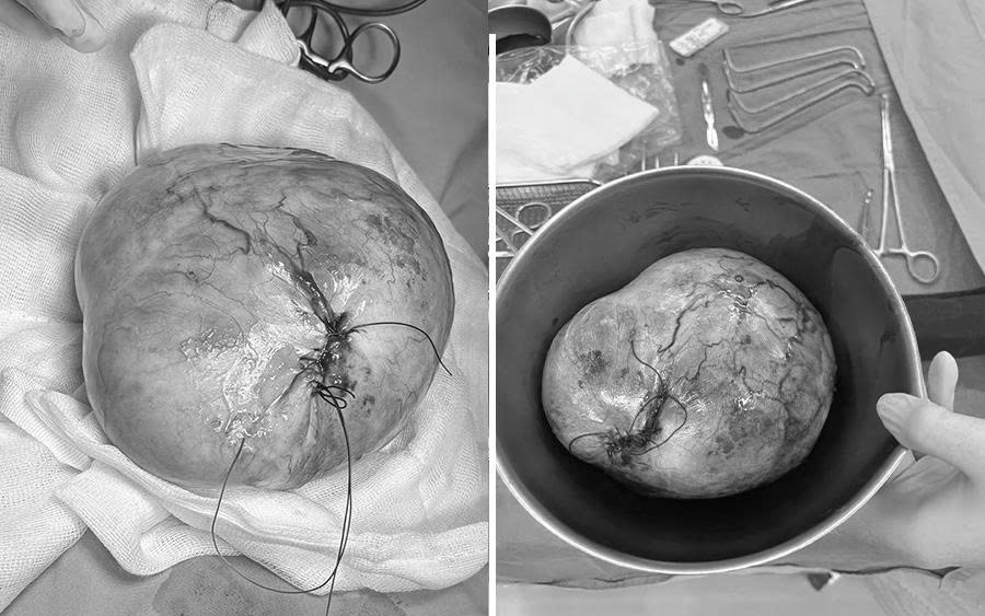 Phenikaa phẫu thuật thành công cho bé gái 9 tuổi mắc u quái buồng trứng 20 cm, bảo toàn khả năng sinh sản