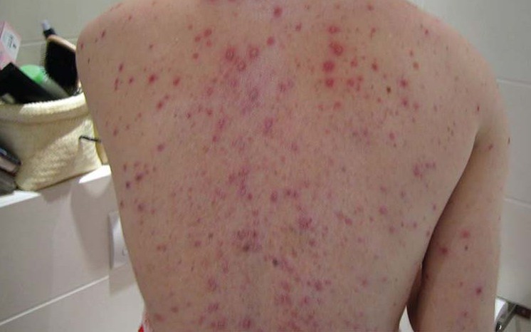 Nguy cơ biến chứng thủy đậu từ việc dùng thuốc sai cách 1 benh thuy dau 17654356161732028913970 0 13 466 759 crop 1765435620896931743892