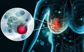 Nghiên cứu vaccine mới mở ra hy vọng chống lại ung thư vú thể nguy hiểm nhất 1 ung thu vu 1 17656306156741076985233 0 24 181 314 crop 17656306204592116277531