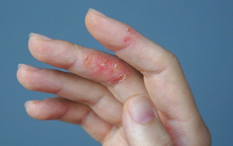 Nhiễm nấm, viêm da mùa mưa cần cảnh giác khi độ ẩm tăng cao- Ảnh 2. 6 lưu ý quan trọng cho người bị viêm da cơ địa khi thời tiết khô hanh