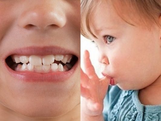 Điều trị sớm khớp cắn ngược răng sữa ở trẻ- Ảnh 1. Điều trị sớm khớp cắn ngược răng sữa ở trẻ- Ảnh 1.