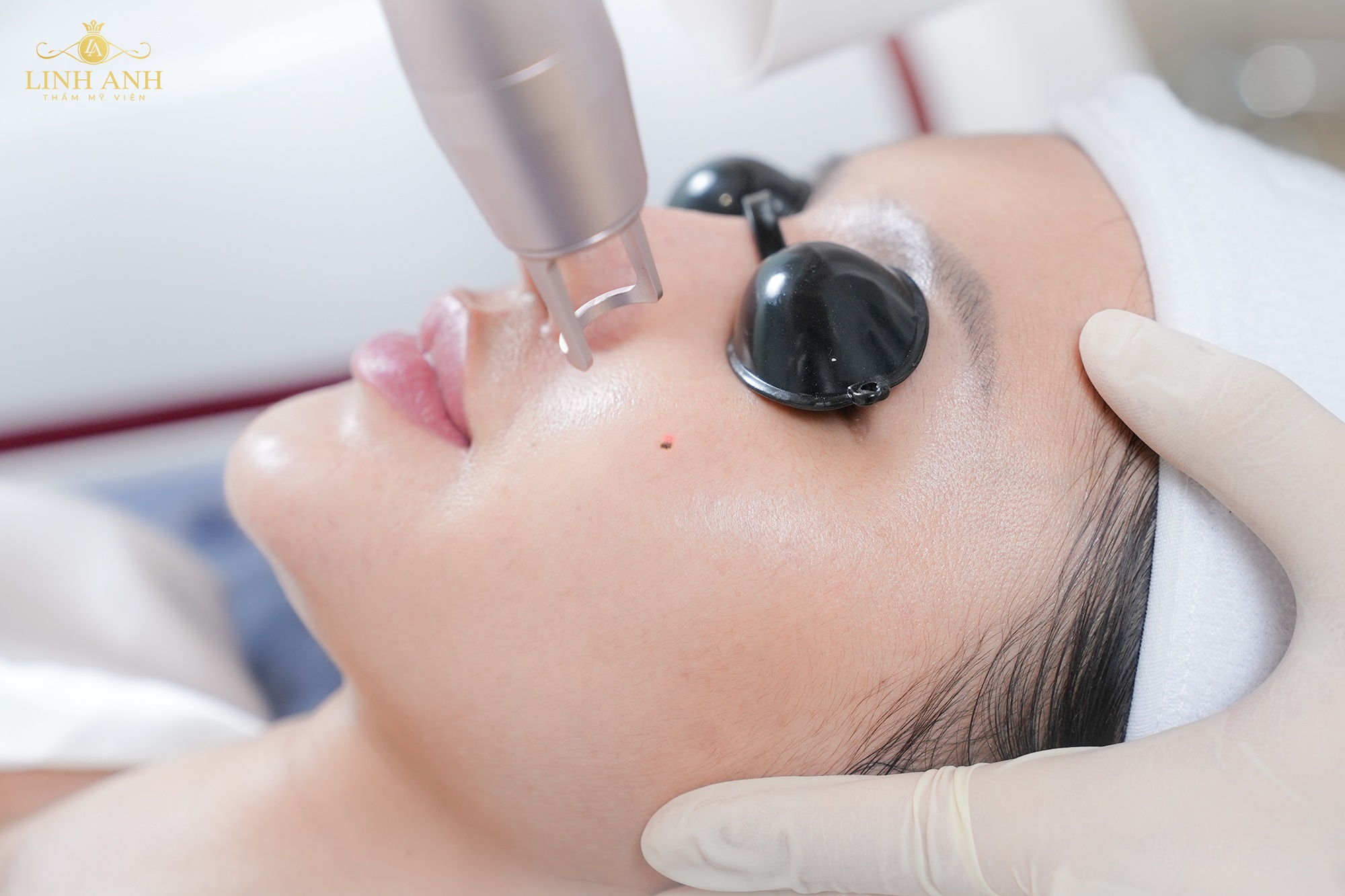 Thẩm mỹ Linh Anh khẳng định chất lượng dịch vụ tẩy nốt ruồi- Ảnh 2. Thẩm mỹ Linh Anh khẳng định chất lượng dịch vụ tẩy nốt ruồi- Ảnh 2.
