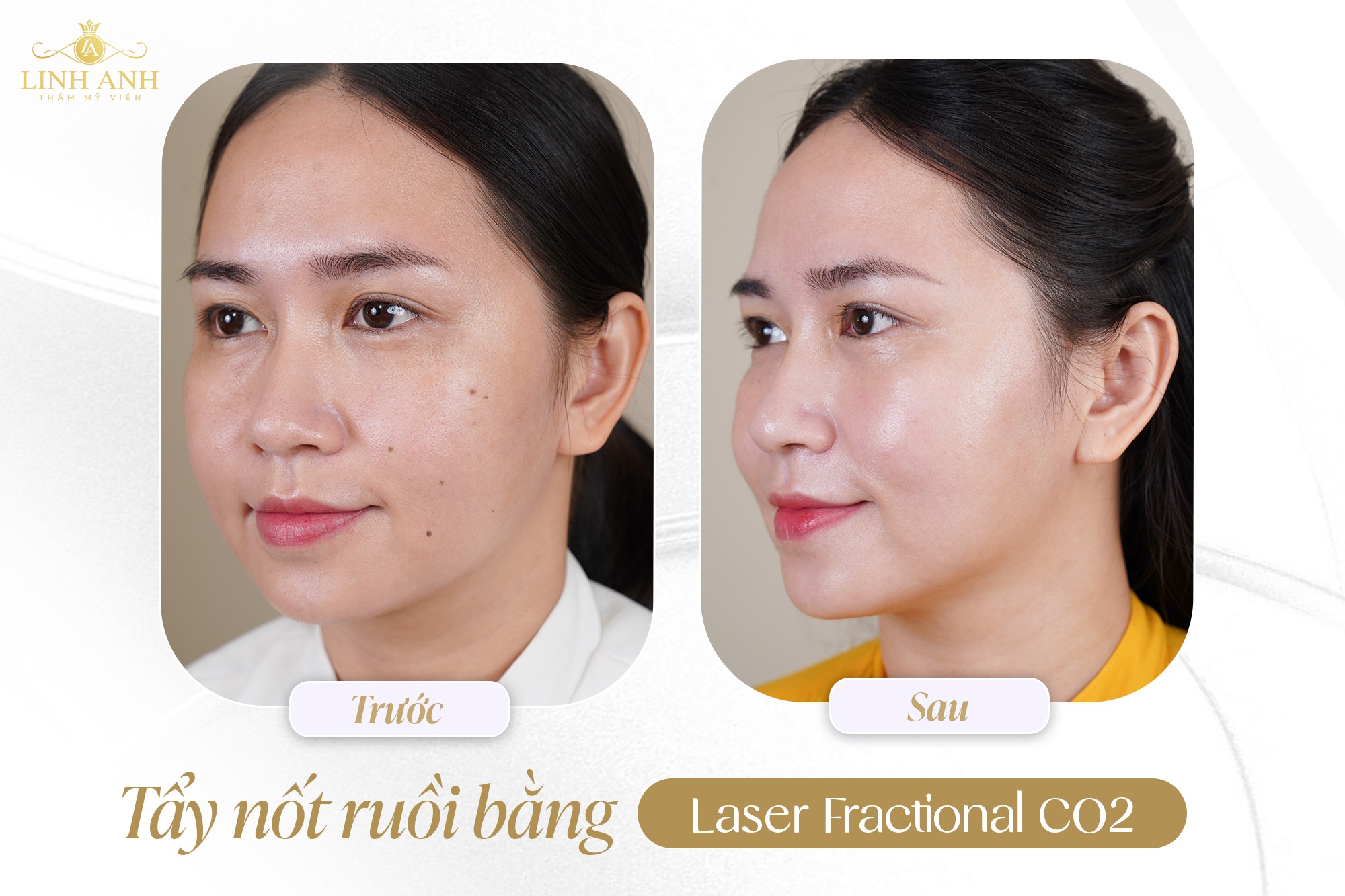 Thẩm mỹ Linh Anh khẳng định chất lượng dịch vụ tẩy nốt ruồi- Ảnh 4. Thẩm mỹ Linh Anh khẳng định chất lượng dịch vụ tẩy nốt ruồi- Ảnh 4.