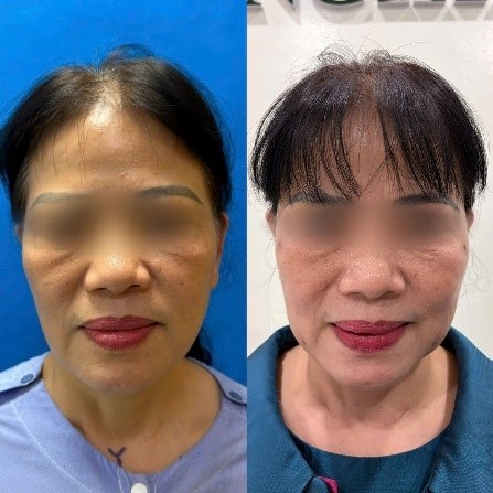 Bác sĩ trẻ Hà Nội mang kỹ thuật trẻ hóa 'không sẹo' ra mắt tại Hội thi kỹ thuật sáng tạo- Ảnh 3. Bác sĩ trẻ Hà Nội mang kỹ thuật trẻ hóa 'không sẹo' ra mắt tại Hội thi kỹ thuật sáng tạo- Ảnh 3.