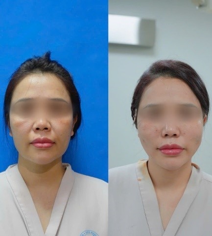 Bác sĩ trẻ Hà Nội mang kỹ thuật trẻ hóa 'không sẹo' ra mắt tại Hội thi kỹ thuật sáng tạo- Ảnh 4. Bác sĩ trẻ Hà Nội mang kỹ thuật trẻ hóa 'không sẹo' ra mắt tại Hội thi kỹ thuật sáng tạo- Ảnh 4.