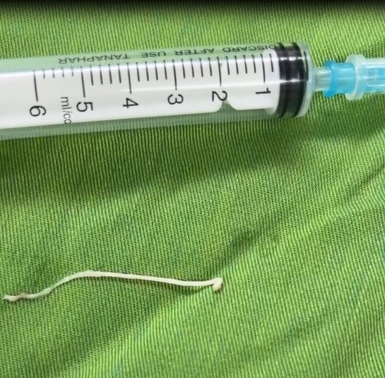 Phẫu thuật khối u, phát hiện ký sinh trùng dạng sán trong vùng hố chậu bệnh nhân- Ảnh 1. Phẫu thuật khối u, phát hiện ký sinh trùng dạng sán trong vùng hố chậu bệnh nhân- Ảnh 1.