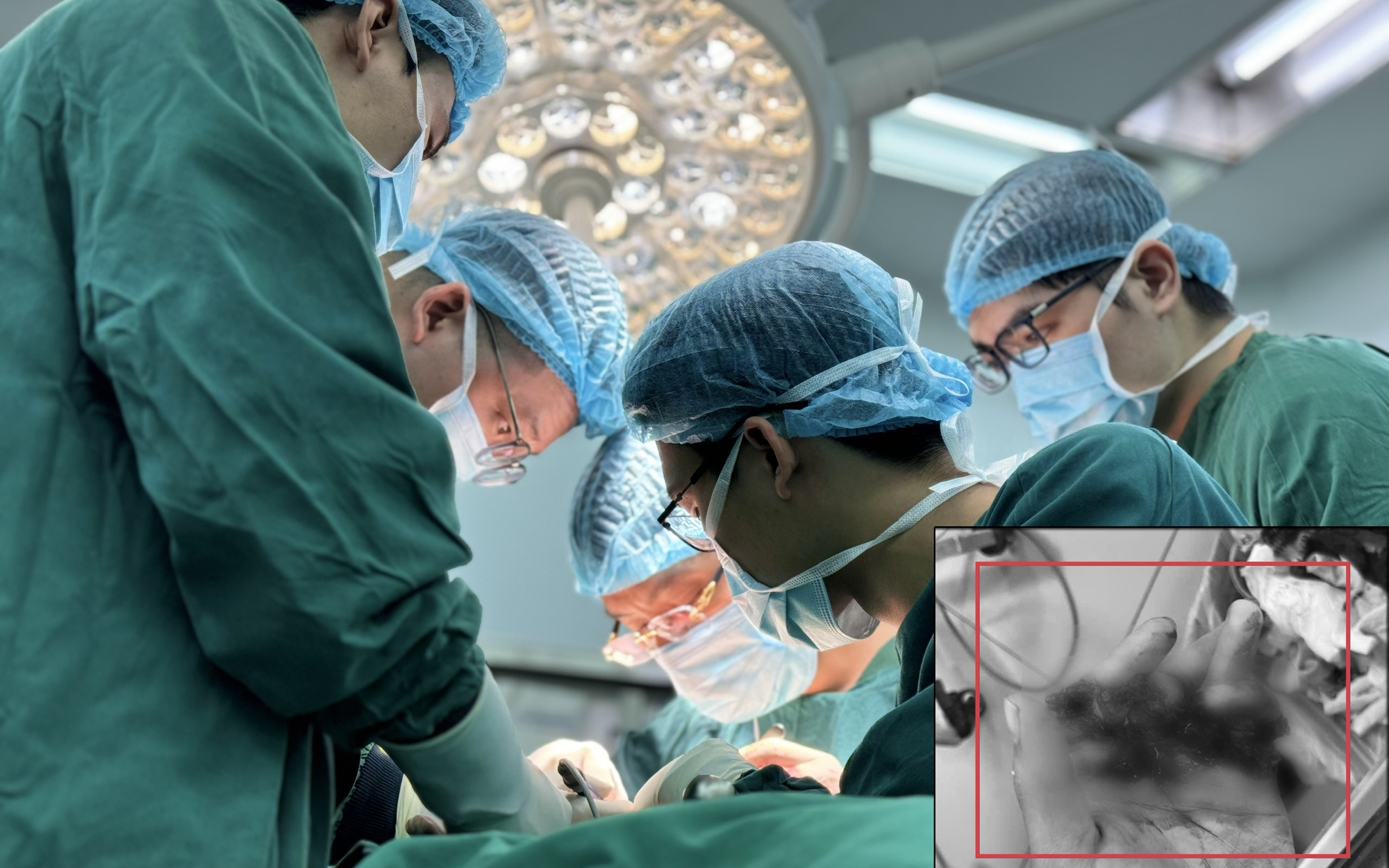 Nối thành công 4 ngón tay gần đứt rời cho bệnh nhân 25 tuổi