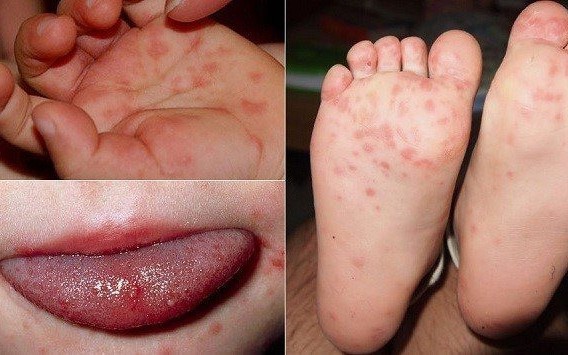 Bệnh tay chân miệng dùng thuốc như thế nào?