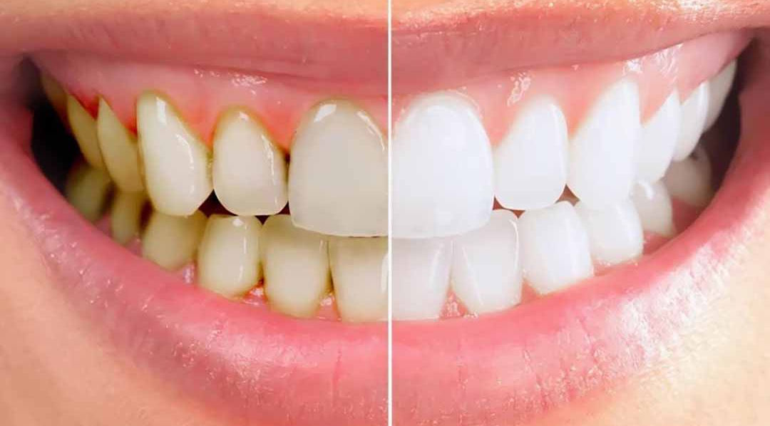 4 cách vệ sinh đúng cho bệnh nhân viêm nha chu- Ảnh 1.