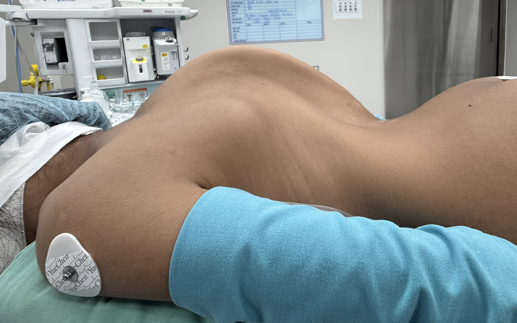 Ngã tại nhà, bé 3 tháng tuổi bị lõm đầu và xuất huyết nội sọ- Ảnh 2.