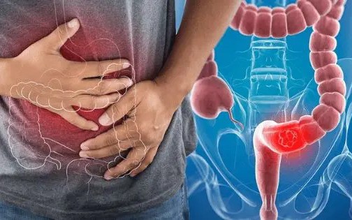 Ung thư đại trực tràng: Những dấu hiệu cảnh báo không nên bỏ qua- Ảnh 2.