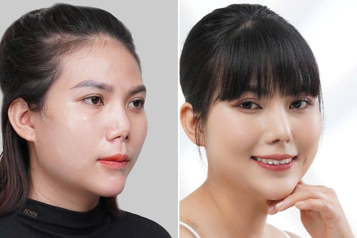 Nâng mũi: Ít can thiệp không đồng nghĩa với an toàn- Ảnh 3.