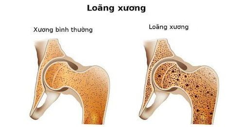 Loãng xương ảnh hưởng đến sức khỏe răng miệng | Vinmec