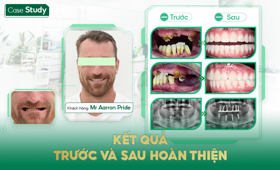 Nha khoa Santé Nha Trang – Điểm đến tin cậy cho cấy ghép Implant và phục hình răng sứ chất lượng cao- Ảnh 3.