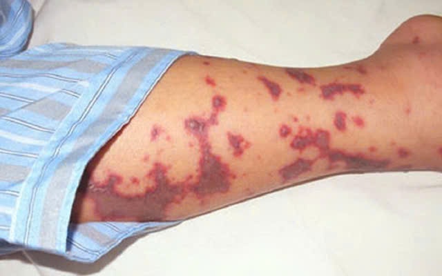 Số ca mắc bệnh do não mô cầu tăng, chuyên gia y tế khuyến cáo gì đến cộng đồng?