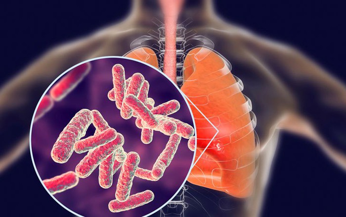 Thời gian ủ bệnh viêm phổi bao lâu?- Ảnh 1.