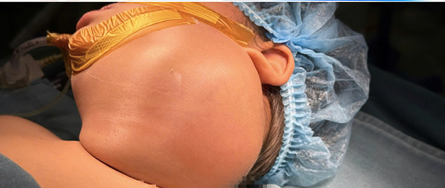 Các biến chứng của u nang bạch huyết ở trẻ em- Ảnh 1. Các biến chứng của u nang bạch huyết ở trẻ em- Ảnh 1.