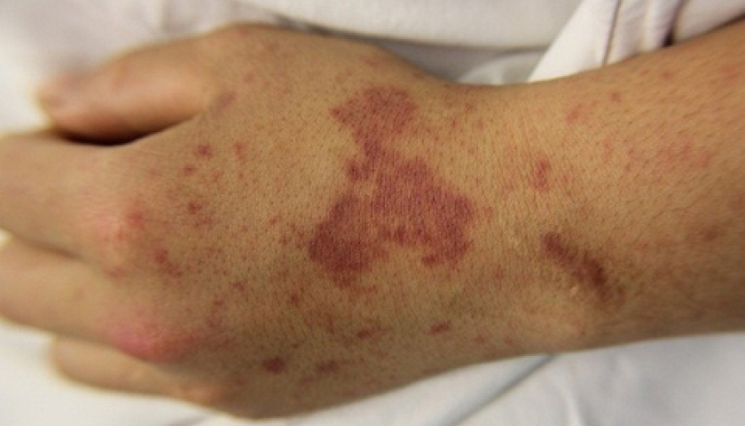 Chuyên gia khuyên gì về căn bệnh truyền nhiễm có thể gây tử vong trong 24h?- Ảnh 2. Chuyên gia khuyên gì về căn bệnh truyền nhiễm có thể gây tử vong trong 24h?- Ảnh 2.