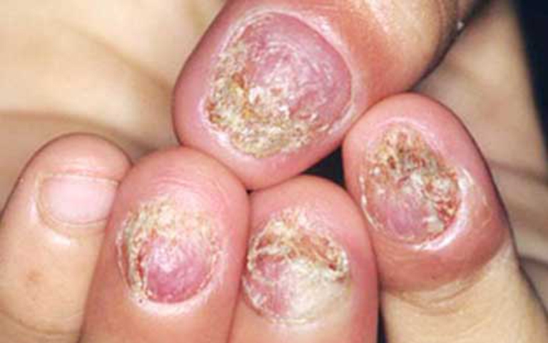 Điều trị hiệu quả nấm móng tay, móng chân