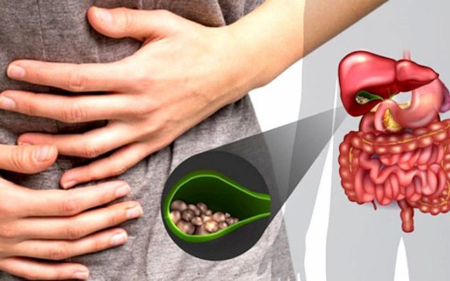 Tán sỏi qua da cho người đàn ông bị biến dạng cột sống 18 năm- Ảnh 4. Tán sỏi qua da cho người đàn ông bị biến dạng cột sống 18 năm- Ảnh 4.