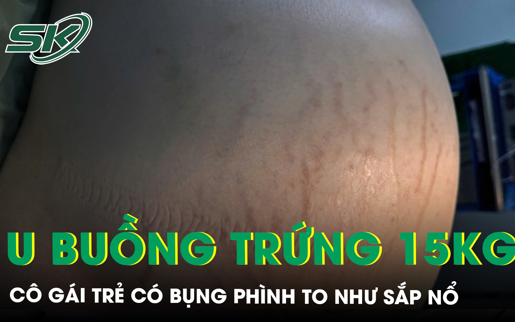 Phẫu thuật kịp thời cứu buồng trứng, giữ cơ hội làm mẹ cho thiếu nữ 17 tuổi- Ảnh 2.