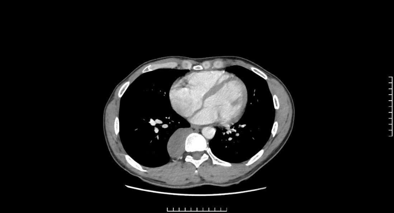 Ung man med bakre mediastinumtumör, farliga komplikationer - Foto 1. Nam thanh niên có khối u trung thất sau, biến chứng nguy hiểm - Ảnh 1.