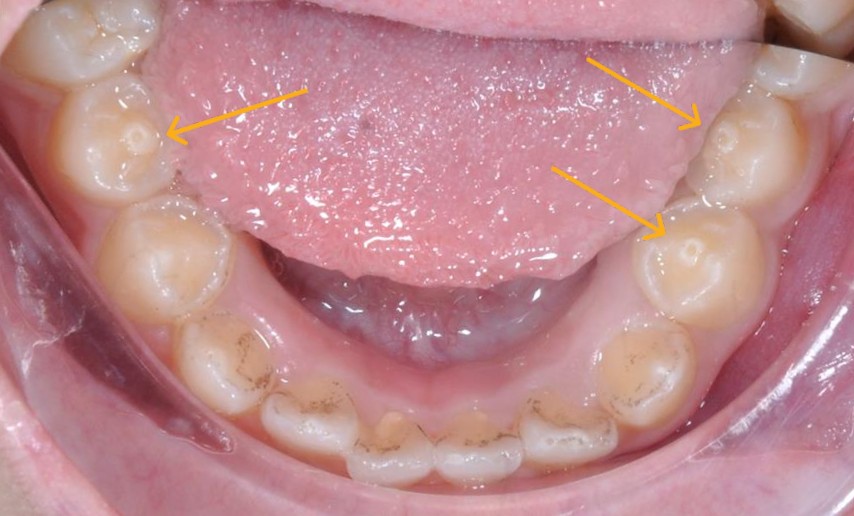 Răng có núm phụ – nguy cơ biến chứng nếu không điều trị kịp thời- Ảnh 1. Răng có núm phụ – nguy cơ biến chứng nếu không điều trị kịp thời- Ảnh 1.