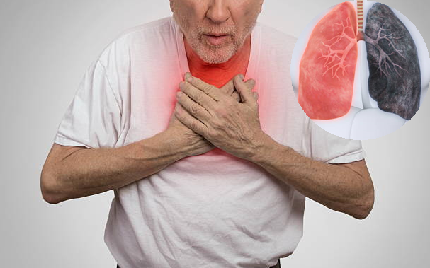 Hà Nội cao điểm ô nhiễm không khí, hàng loạt điểm cảnh báo màu tím- Ảnh 2. Người mắc phổi tắc nghẽn mạn tính cần làm gì khi ô nhiễm không khí gia tăng?