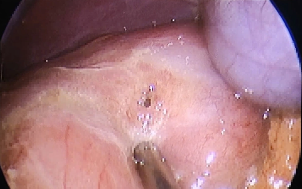 Cháu bé 26 tháng tuổi mắc khối u nang lớn, hiếm gặp, chèn ép gần một nửa vùng bụng phải- Ảnh 4. Cháu bé 26 tháng tuổi mắc khối u nang lớn, hiếm gặp, chèn ép gần một nửa vùng bụng phải- Ảnh 4.